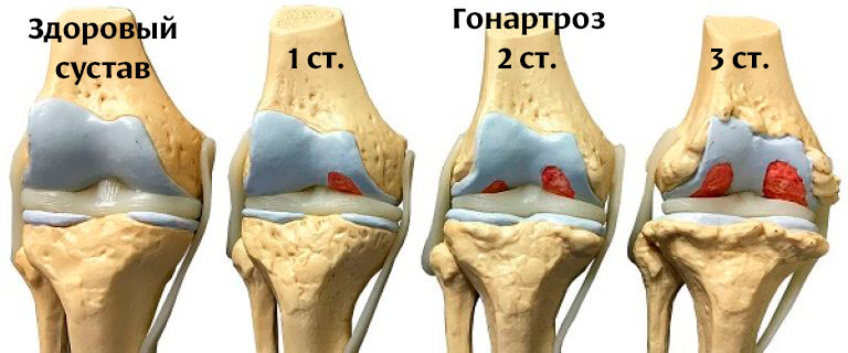 стадії артрозу колінного суглобу