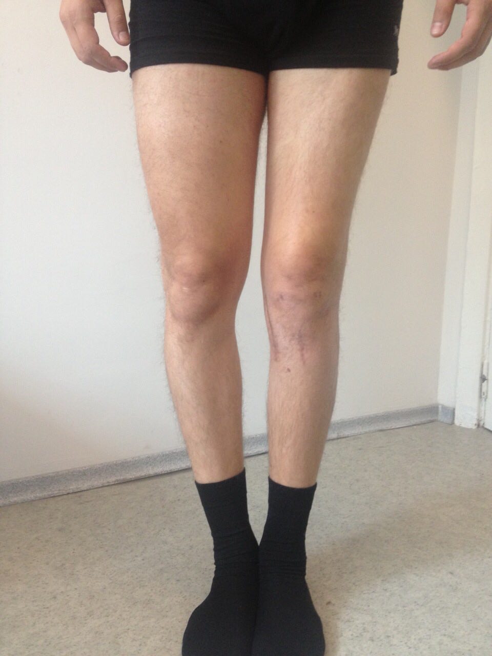 Артроз, деформація коліна - фото