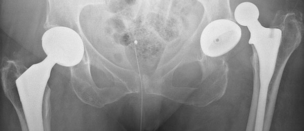 вивих головки тазу