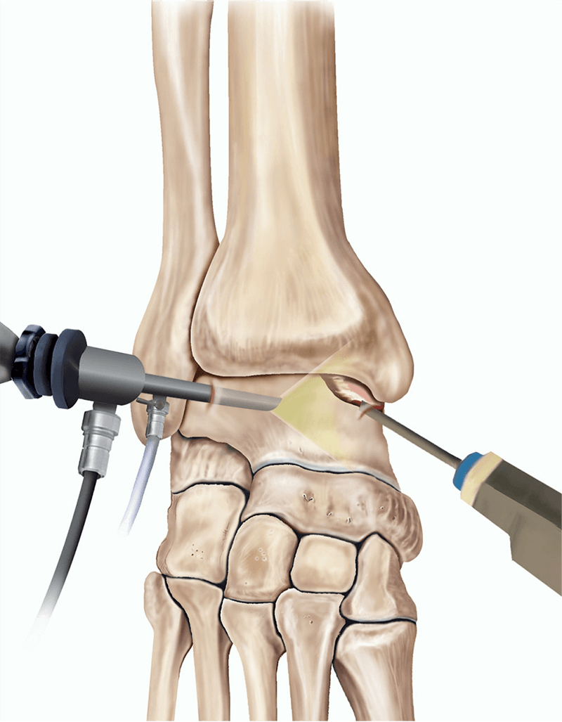 Артроскопия голеностопа. Показания к артроскопии на голеностопе.  Преимущества артроскопии.
