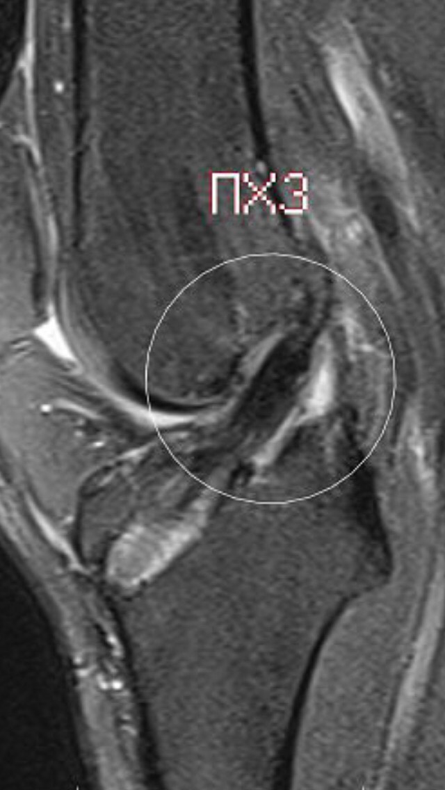 коліно після пластики ПКС - МРТ
