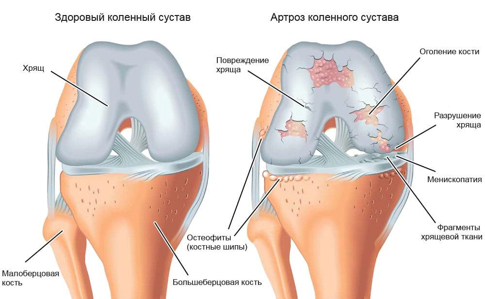 хвороби колінного суглобу