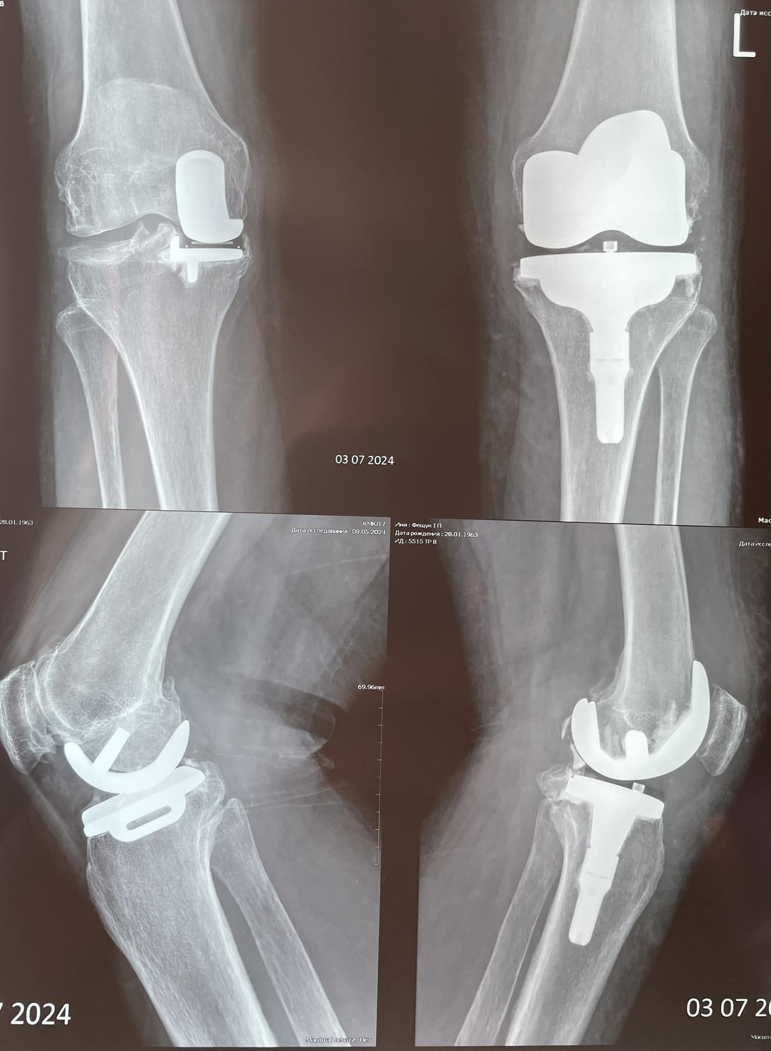 Пример разных эндопротезирований колен у одной пациентки