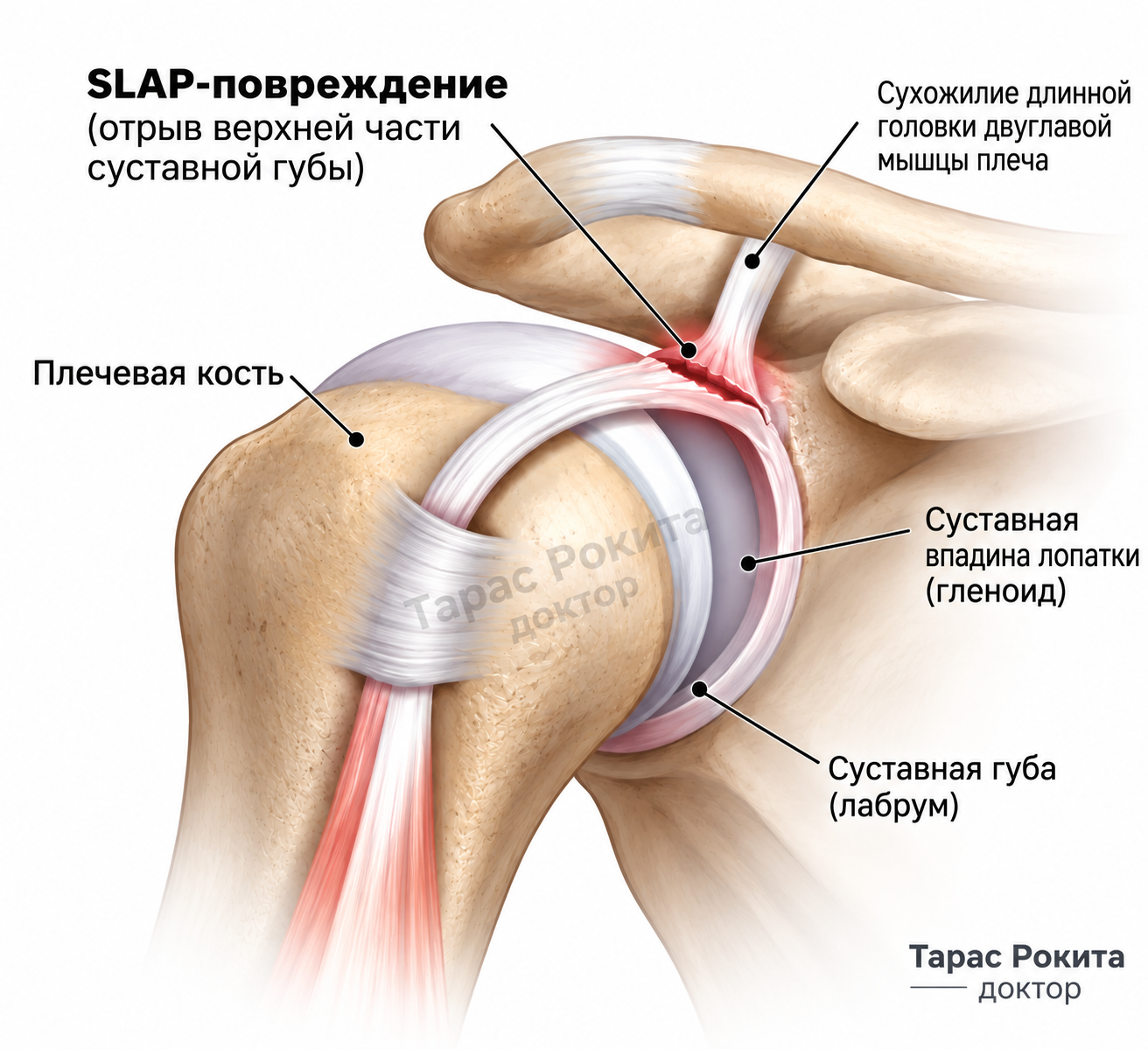 SLAP-повреждение суставной губы плечевого сустава — анатомическая схема