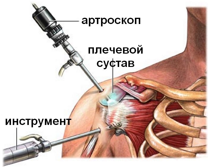 артроскопия плечевого сустава